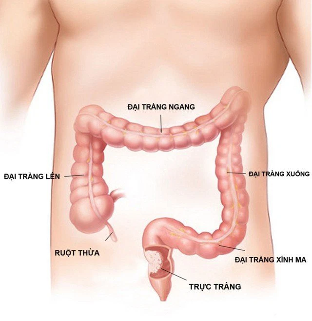 Câu chuyện của Tiểu Trường và ung thư trực tràng chính