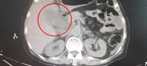 95 viên sỏi túi mật: Bác sĩ cảnh báo nguy hiểm từ thói quen ăn sáng bỏ bữa